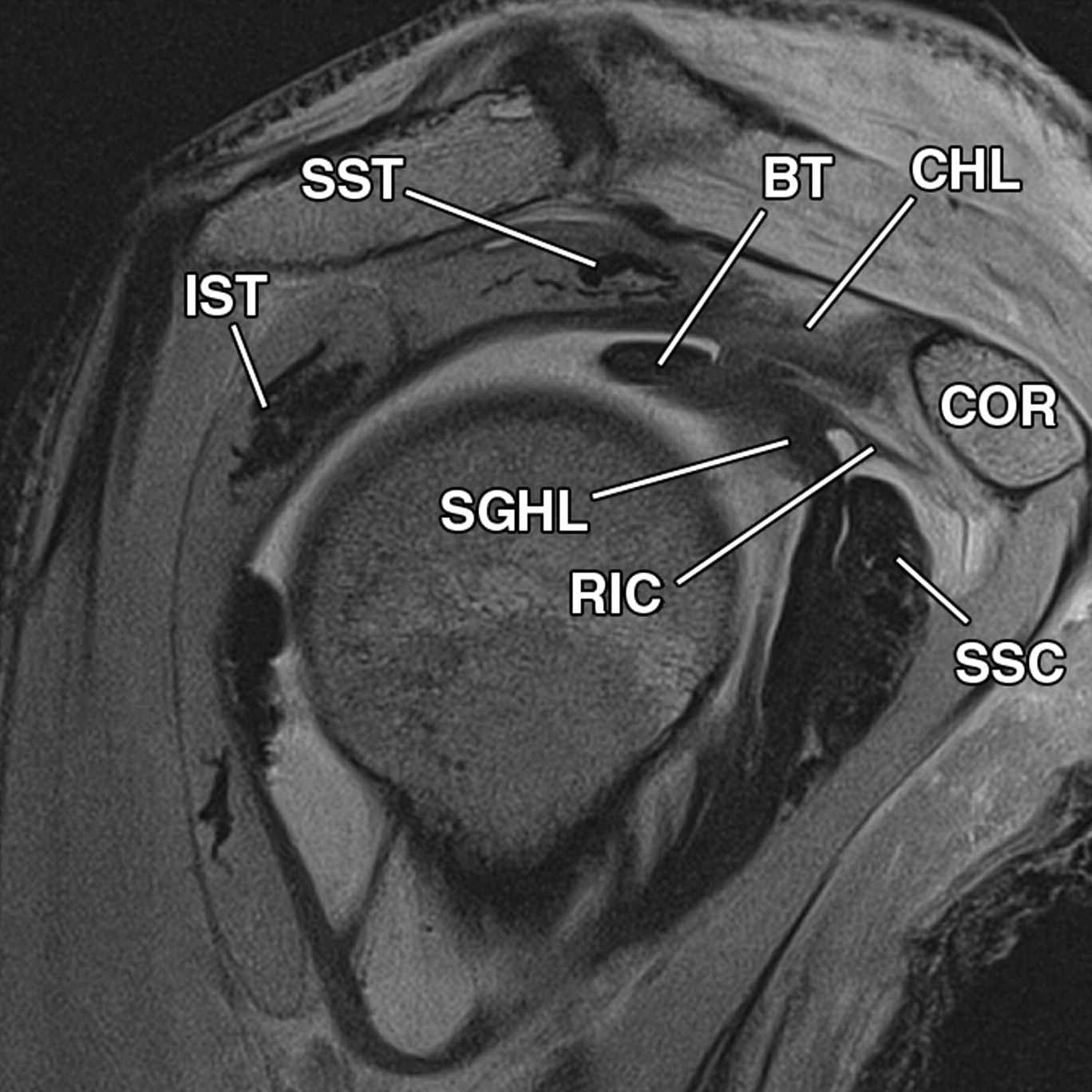 instabilit-del-tendine-capo-lungo-del-bicipite-radiologia-ortopedica